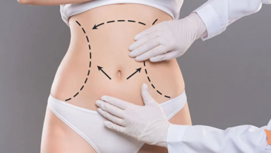 The Role of Liposuction in Treating Lipedema and Other Conditions