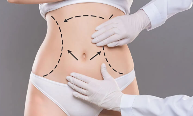 The Role of Liposuction in Treating Lipedema and Other Conditions