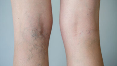 Varicose veins