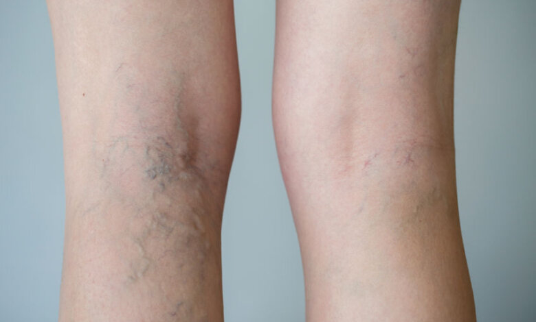 Varicose veins