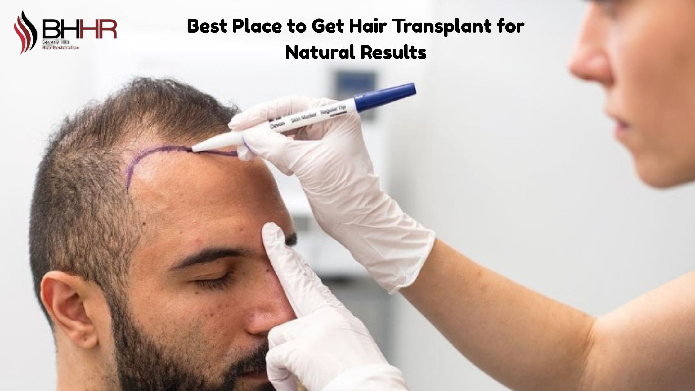 best place to get hair transplant