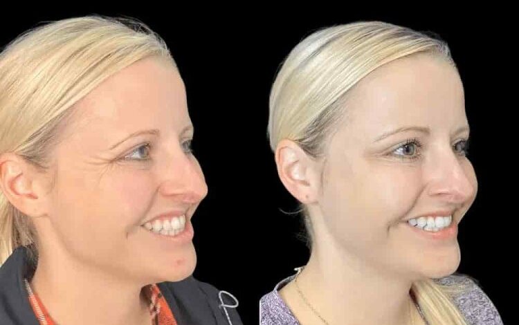 Botox cost in Dubai, Best botox dermatologist in dubai , Best Botox injections in Dubai, Botox injections in Dubai,