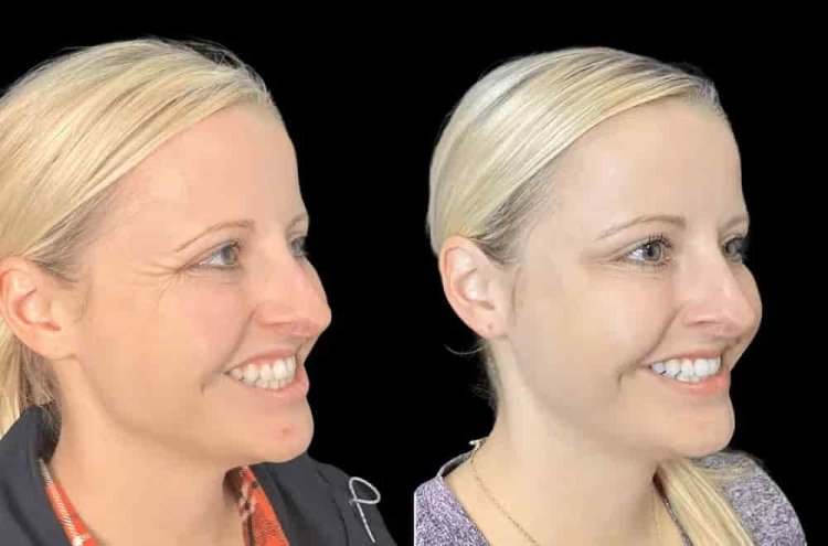 Botox cost in Dubai, Best botox dermatologist in dubai , Best Botox injections in Dubai, Botox injections in Dubai,