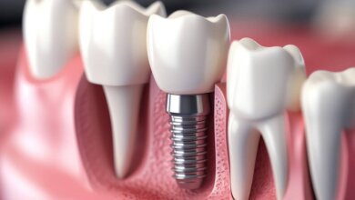 dental implants in Mississauga