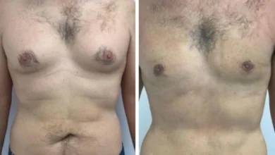 gynecomastia in Dubai