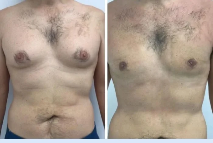gynecomastia in Dubai
