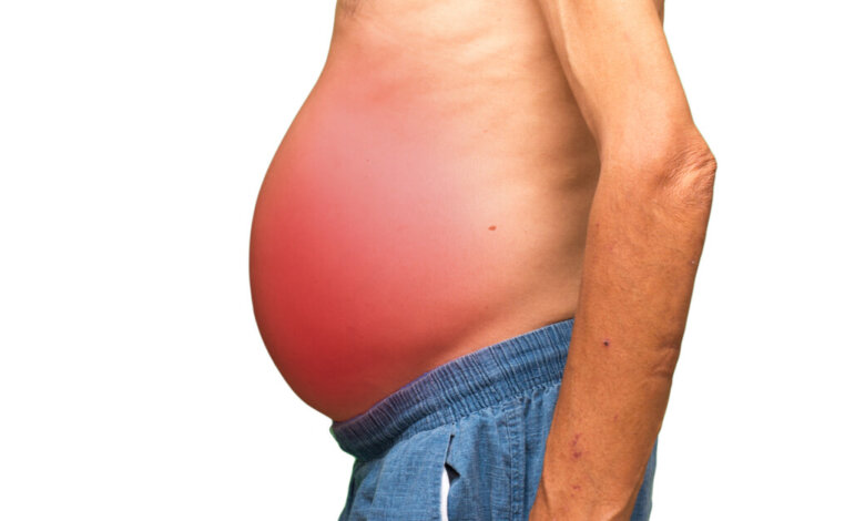 Best Nutrition Tips for Managing Ascites Symptoms
