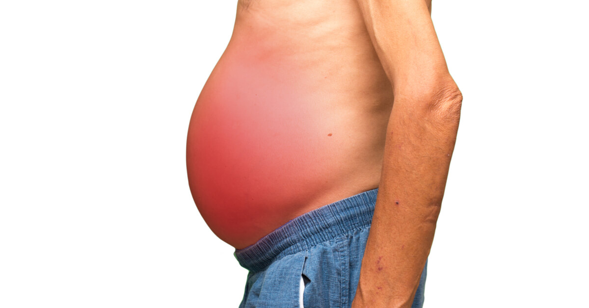 Best Nutrition Tips for Managing Ascites Symptoms