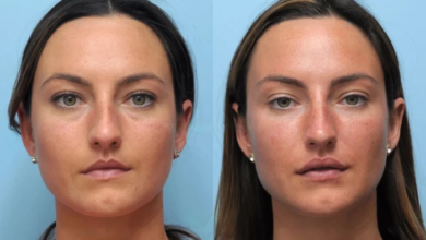 Lift and Tighten with Help from the Best Doctors in Dubai for Thread Lift