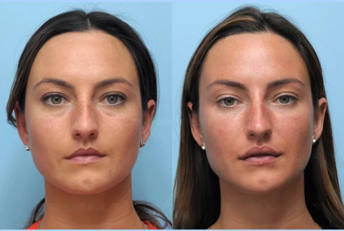 Lift and Tighten with Help from the Best Doctors in Dubai for Thread Lift