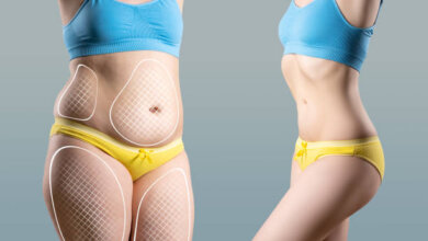 Liposuction in Riyadh