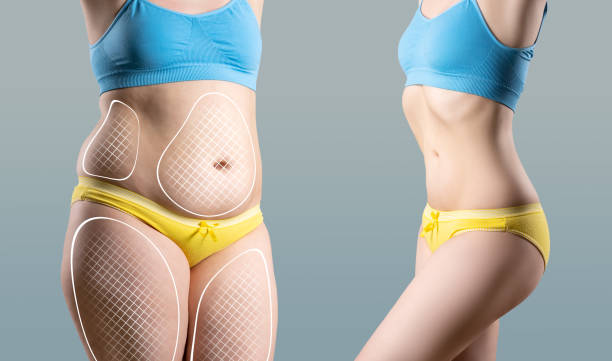 Liposuction in Riyadh