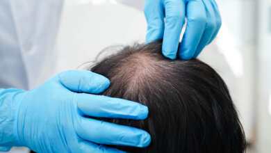 Doctor in clinic treating hair loss.