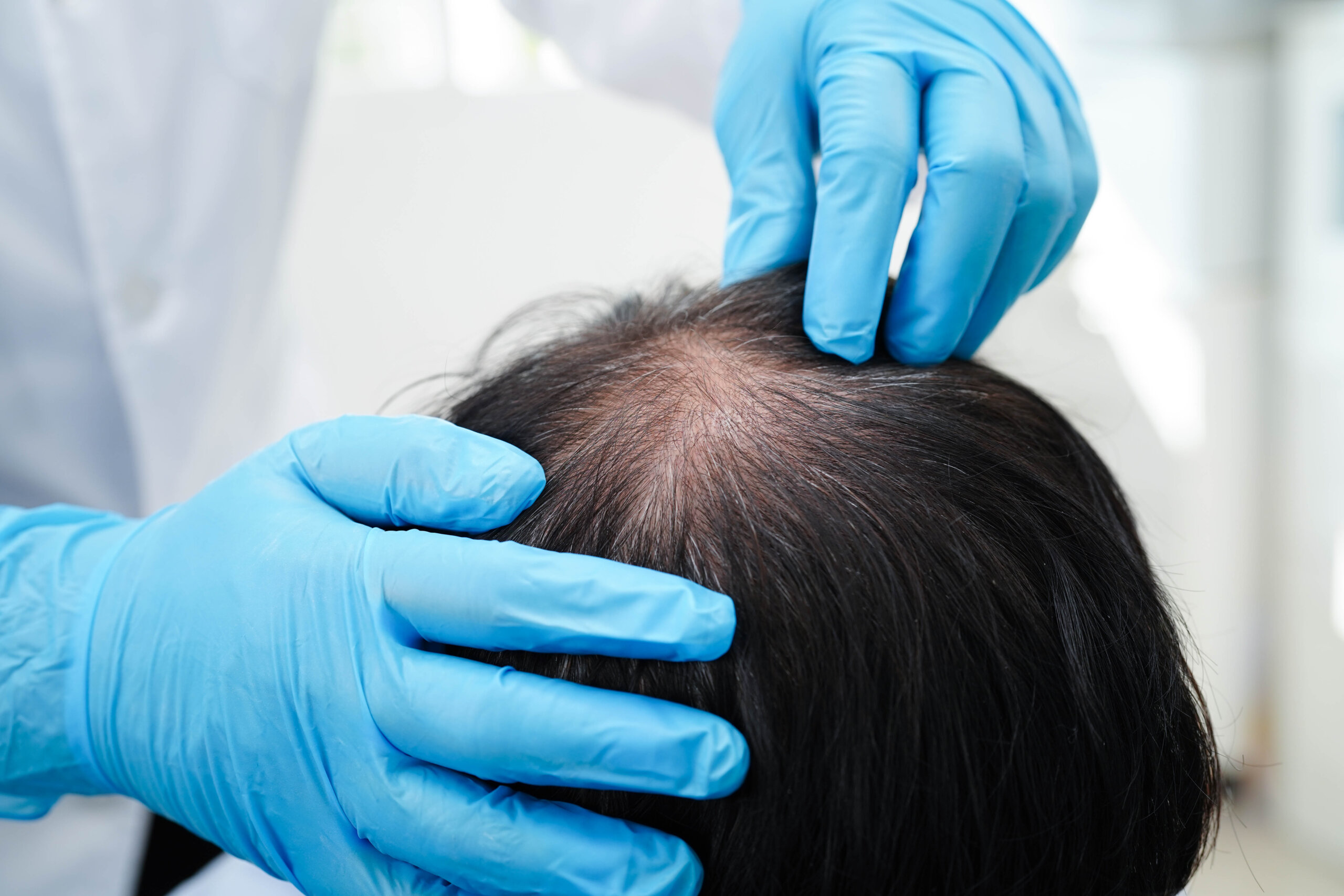 Doctor in clinic treating hair loss.