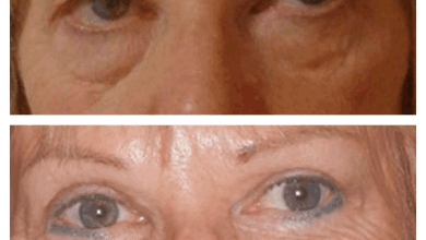 Eye Bag Removal