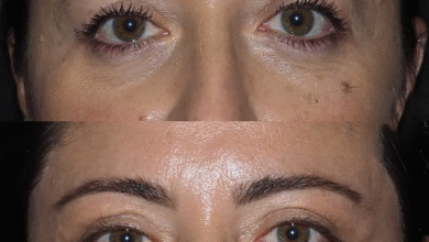 Eye Bag Removal
