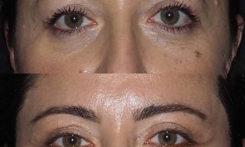 Eye Bag Removal