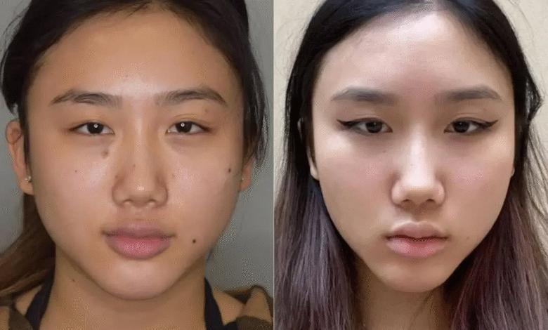 Buccal Fat Removal