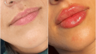 Juvederm