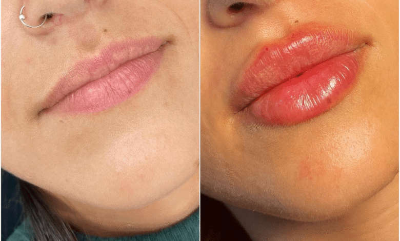 Juvederm