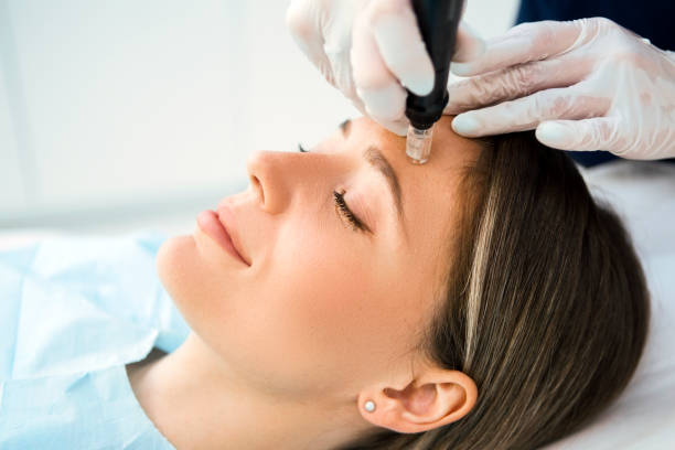 How Derma Pen Treatment Boosts Skin Renewal