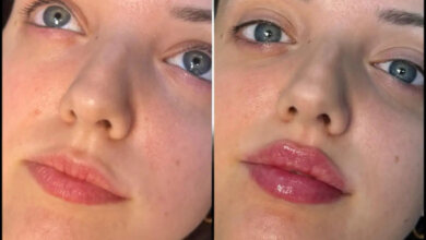 fillers in Dubai
