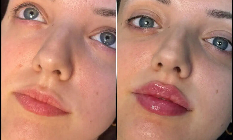 fillers in Dubai