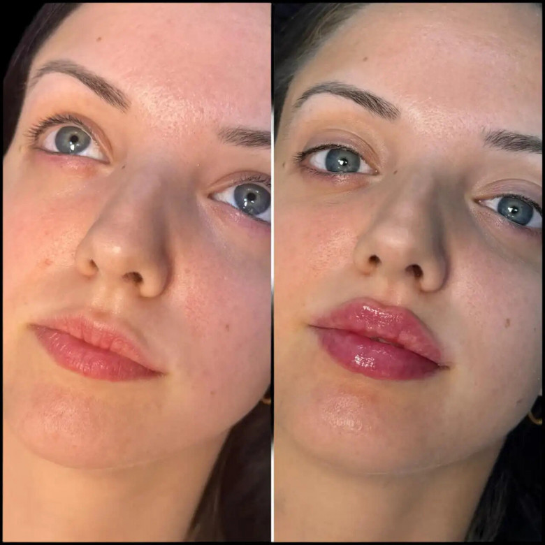 Jawline Fillers in Dubai