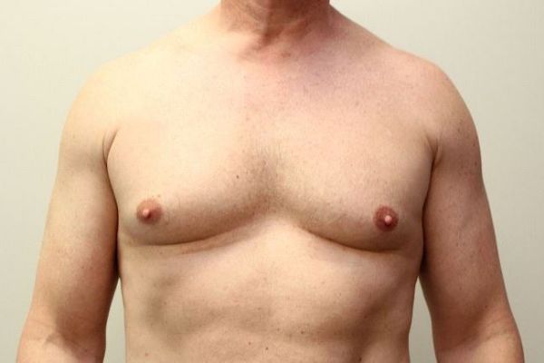 Effective Gynecomastia Surgery Solutions Riyadh