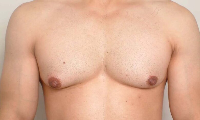 Your Guide to Gynecomastia Surgery in Riyadh