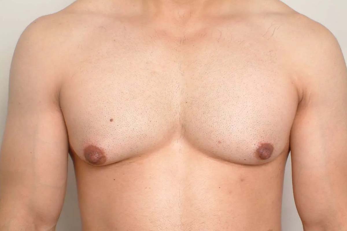 Your Guide to Gynecomastia Surgery in Riyadh