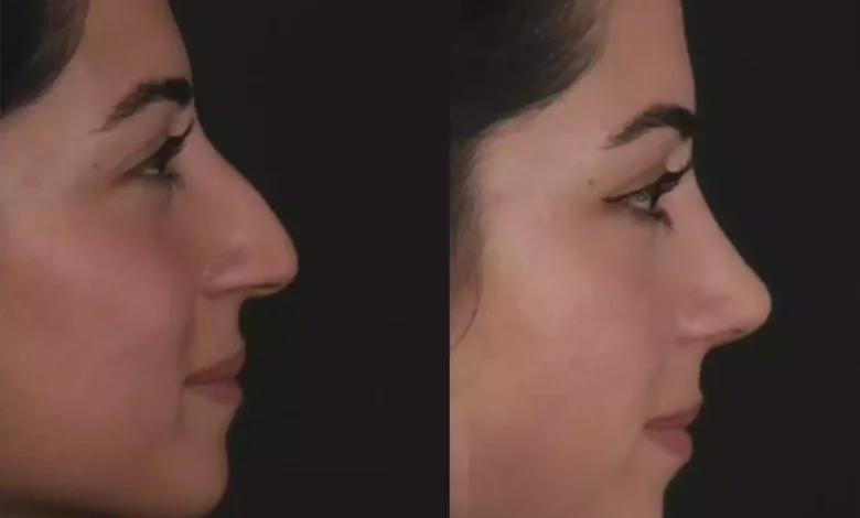 Septoplasty in Dubai