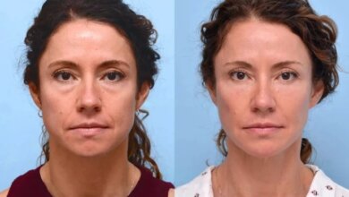 Best Doctors in Dubai: Is Thread Lift Worth It? A Complete Breakdown