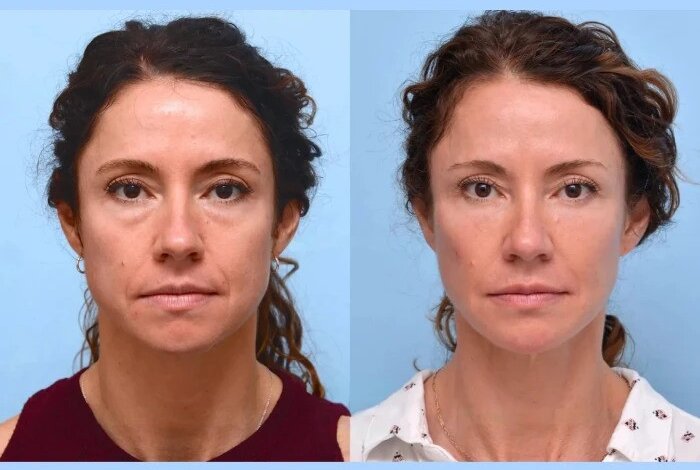 Best Doctors in Dubai: Is Thread Lift Worth It? A Complete Breakdown