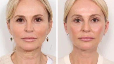 World-Class Care and Precision with Thread Lift by the Best Plastic Surgeons in Dubai
