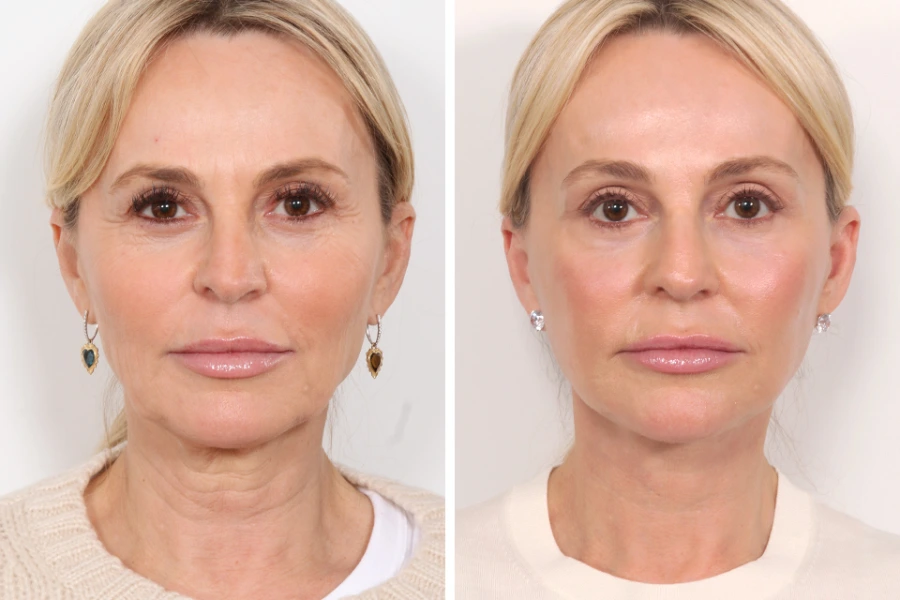 World-Class Care and Precision with Thread Lift by the Best Plastic Surgeons in Dubai