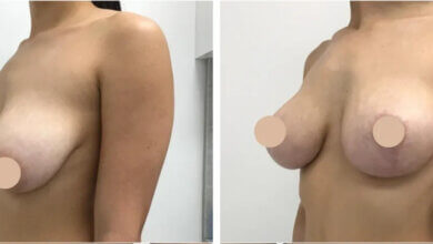 breast lift in dubai