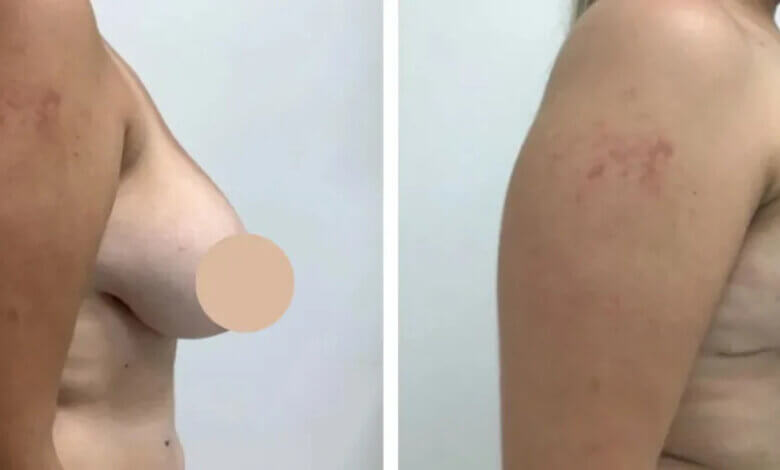breast reduction in dubai