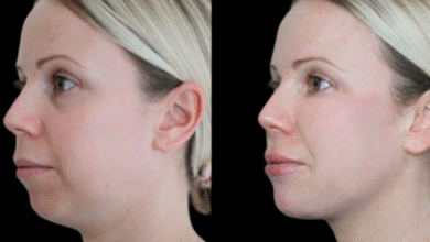 jawline filler in dubai