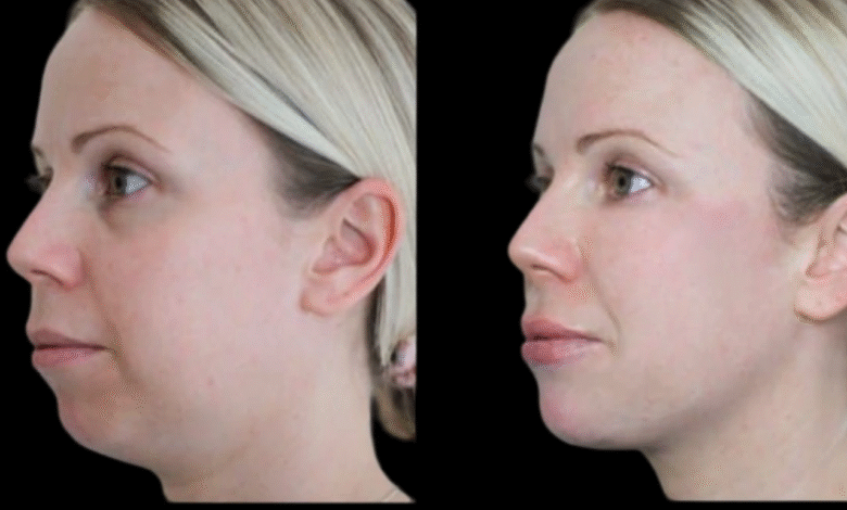 jawline filler in dubai