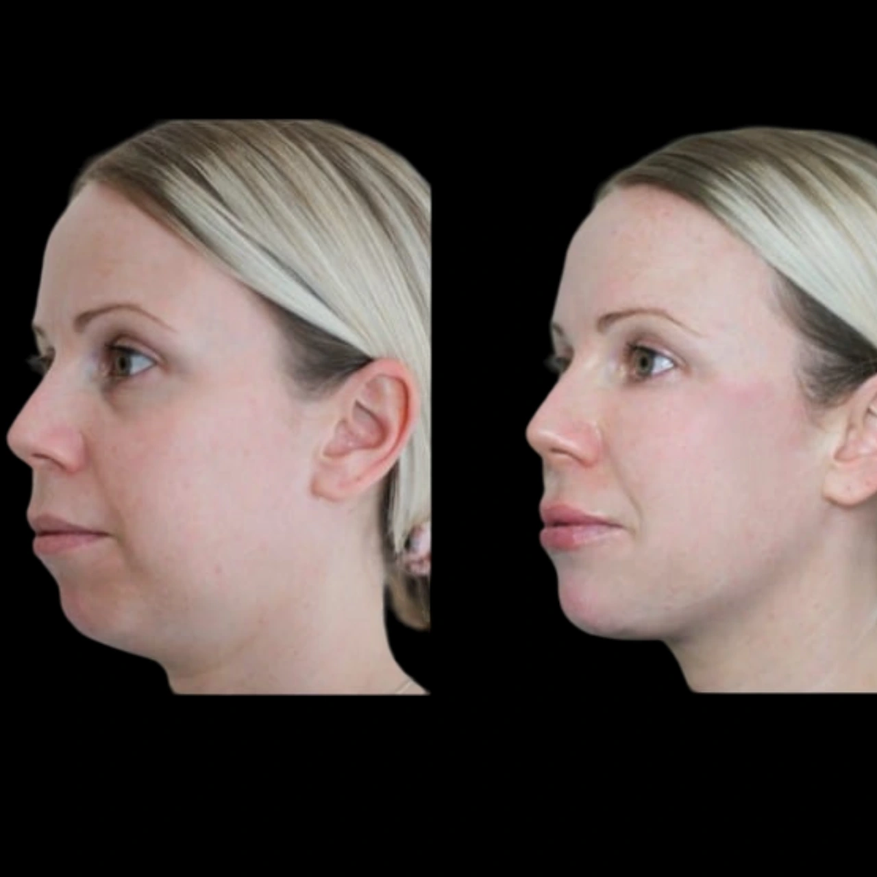 jawline filler in dubai