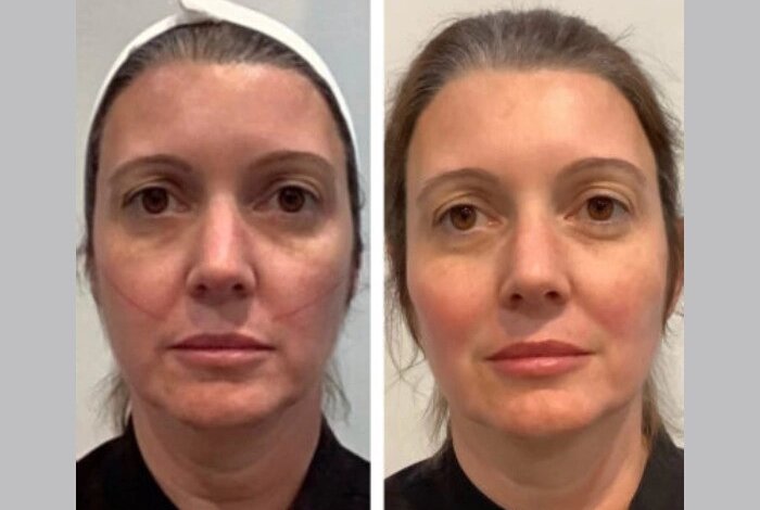Achieve Natural Results with Thread Lift at the Best Aesthetic Clinic in Dubai