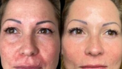 Profhilo treatments in dubai