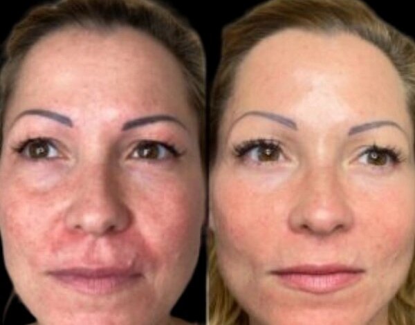 Profhilo treatments in dubai