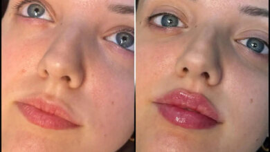 Fillers in Dubai