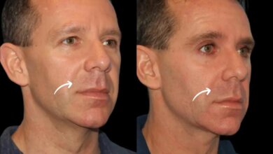 sculptra fillers in dubai