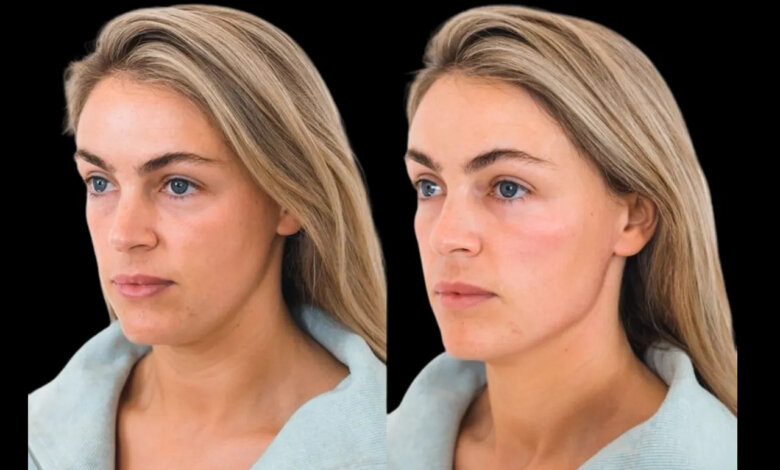 Cheek Fillers in Dubai