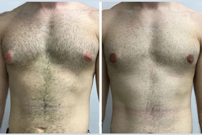 gynecomastia in dubai