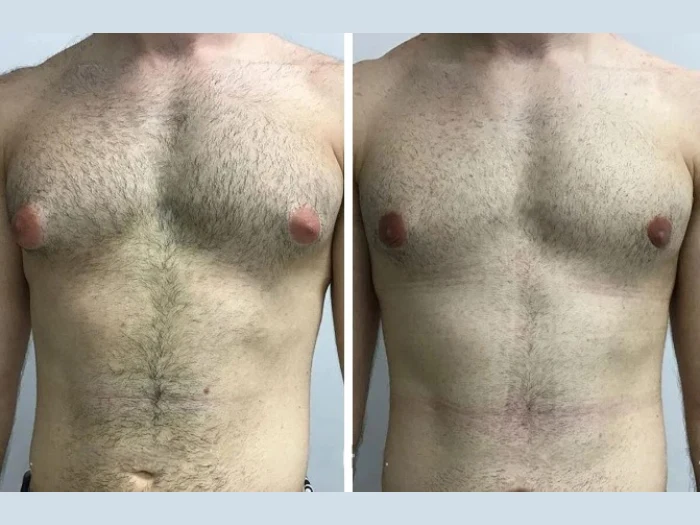 Future of Male Breast Reduction with the Best Gynecomastia Surgeon in Dubai