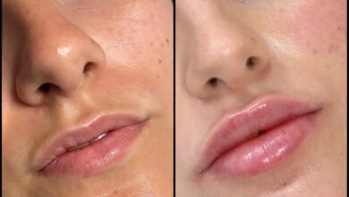 Dermal Fillers in dubai
